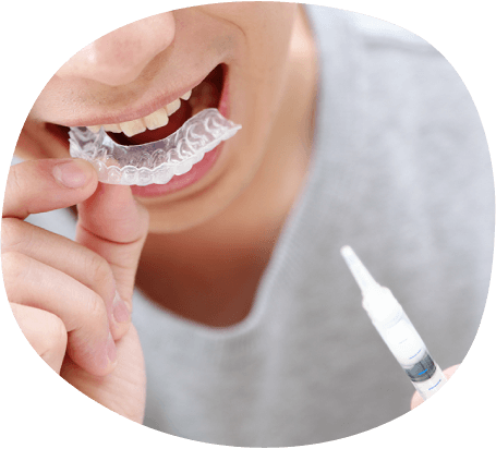 ホームホワイトニングの様子