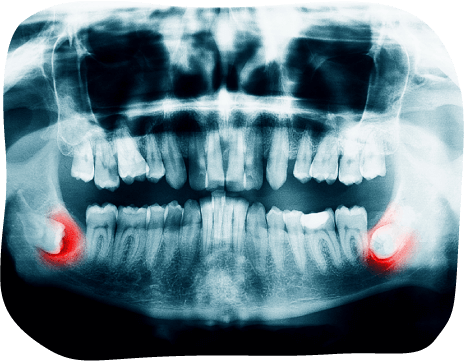 歯のレントゲン写真