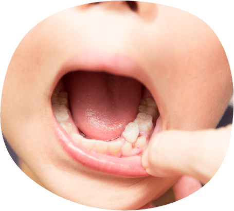 グラグラの乳歯