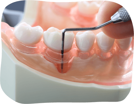歯周ポケットの模型