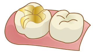 ゴールド インレー