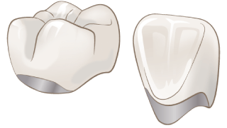 メタルボンド クラウン