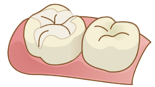 ジルコニア インレー